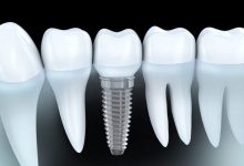 آنچه در مورد ایمپلنت دندان باید بدانید