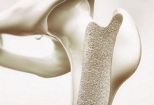 هورمون درمانی به پیشگیری از پوکی استخوان کمک می کند