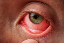 7 نوع عفونت چشم، علائم و نحوه درمان آنها