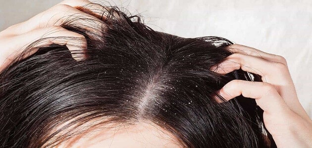 تعبیر خواب حشرات در مو