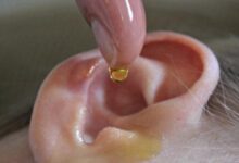 قارچ گوش را در خانه درمان کنید