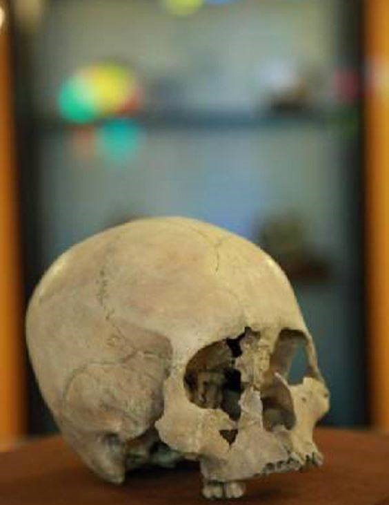 اسکلت 2 جمجمه دختر 13 ساله شهر سوخته در موزه ملی تاریخ علوم پزشکی ایران